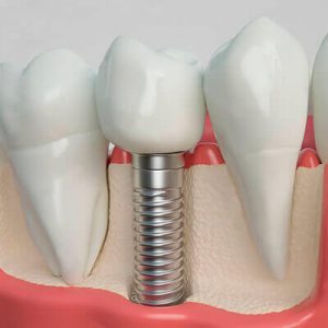 Lonato Que Hacemos Imagen Servicio Implantes Dentales
